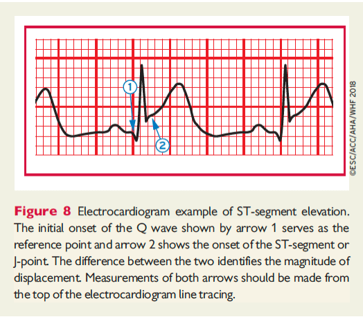 Andra EKG-förändringar vid STEMI: EKG vid vänstergrenblock, pacemaker, posterior infarkt, Huvudstamstenos.