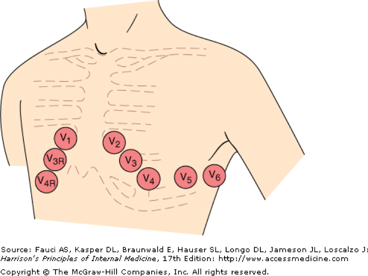 EKG Elektrodplacering av bröstavledningar