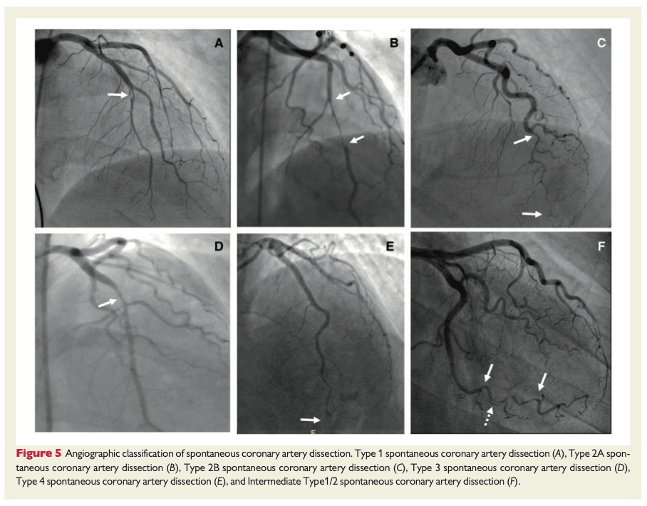 Angiografisk klassifikation för spontana kranskärlsdissektioner (SCAD)