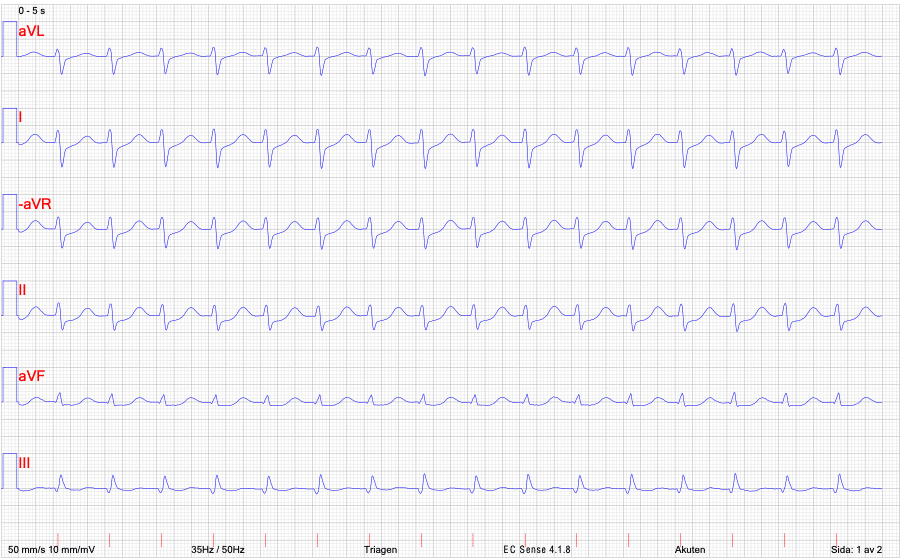 EKG AVNRT, extremitetsavledningar