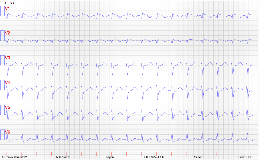 EKG AVNRT, bröstavledningar