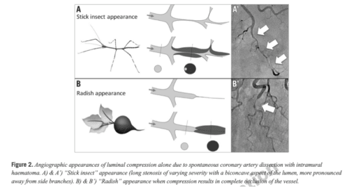"stick insect" eller "rädisa" bild vid angiografi.