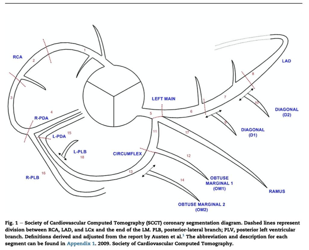 segmentindelning kranskärl på CT kranskärl