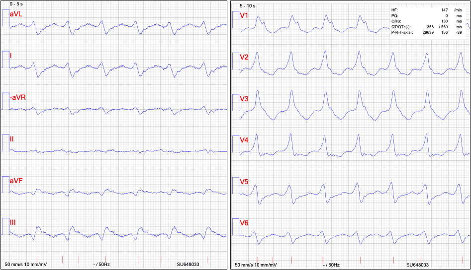 ekg excempel VT