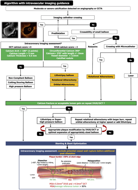 Optimal interventional management of calcified lesions based on intravascular imaging.