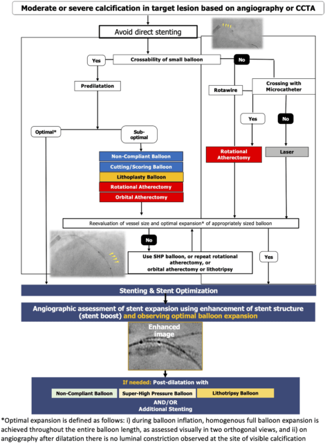 Optimal interventional management of calcified lesions based on coronary angiografi
